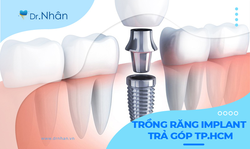 Trồng răng Implant trả góp TP.HCM