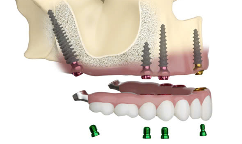 Implant Pterygoid được cố định vững chắc vào phần xương bướm