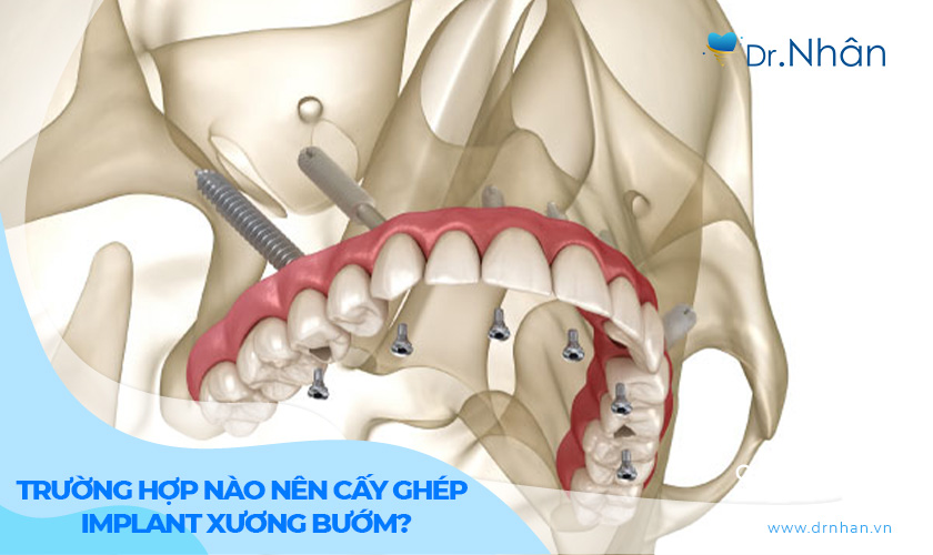 Trường hợp nào nên cấy ghép Implant xương bướm