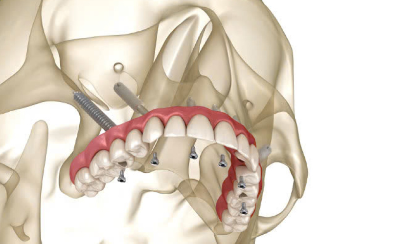 Cấy ghép Implant xương bướm mang đến nhiều lợi ích vượt trội