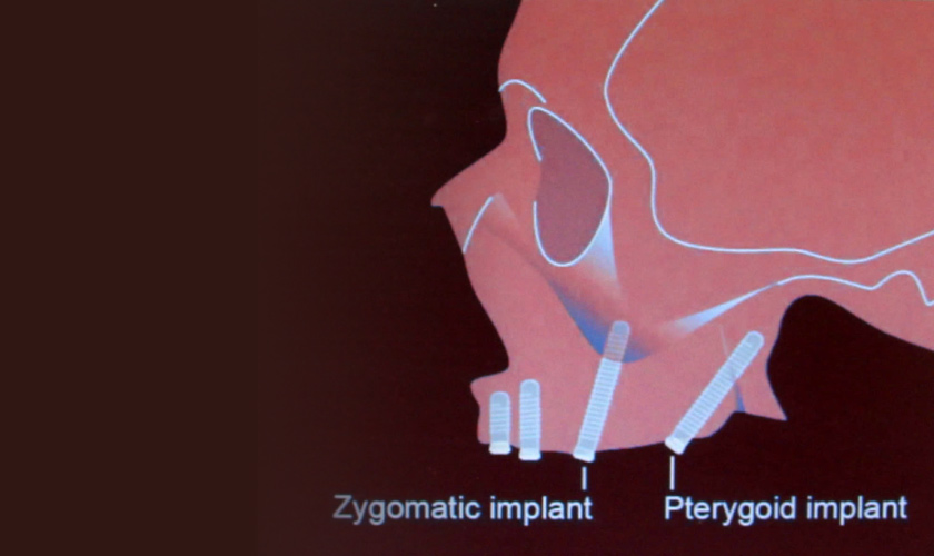 Kết hợp implant xương bướm với implant xương gò má