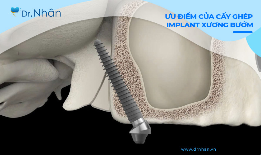 Ưu điểm của cấy ghép Implant xương bướm