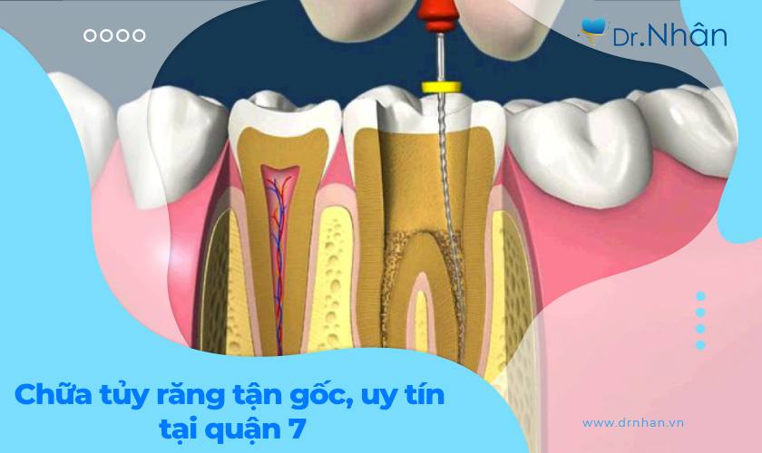 Chữa tủy răng tận gốc - uy tín tại quận 7
