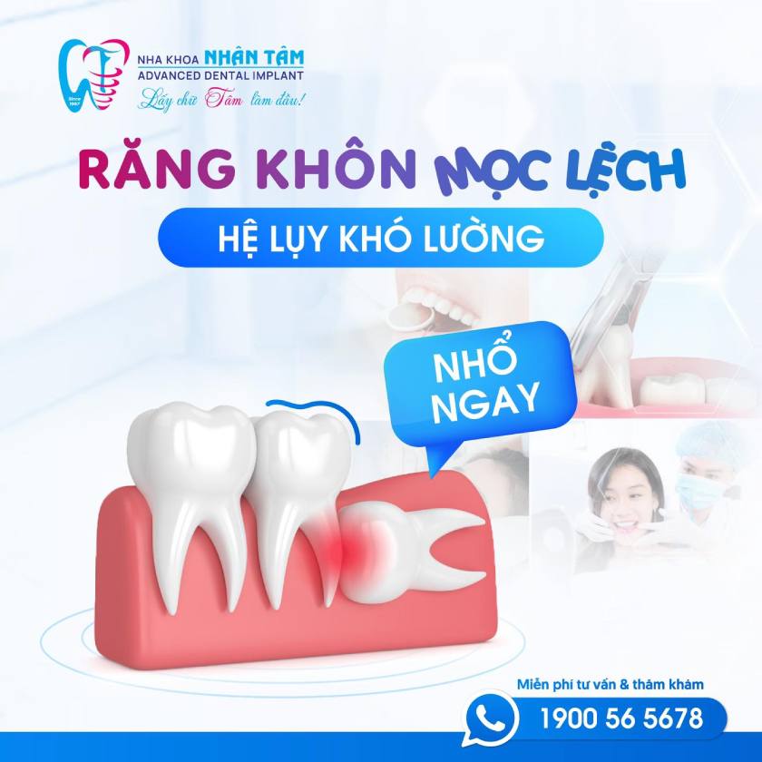 Không đóng vai trò trong quá trình ăn nhai, đồng thời tiềm ẩn nhiều biến chứng nguy hiểm, răng khôn thường được các Bác sĩ nha khoa khuyến khích nhổ bỏ Không đóng vai trò trong quá trình ăn nhai, đồng thời tiềm ẩn nhiều biến chứng nguy hiểm, răng khôn thường được các Bác sĩ nha khoa khuyến khích nhổ bỏ