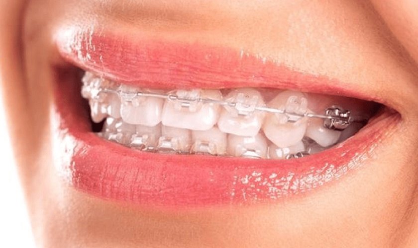 Niềng răng mắc cài sứ mang lại thẩm mỹ cao khi niềng răng