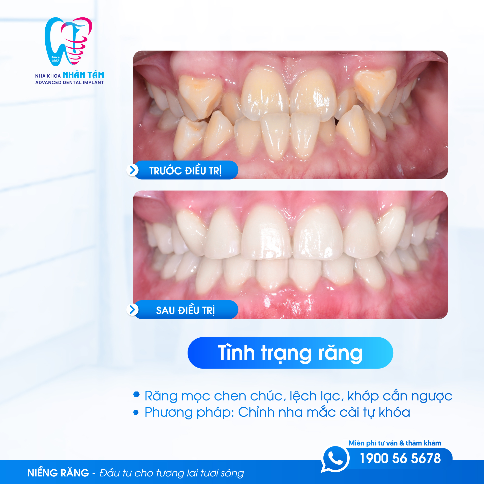 Hình ảnh trước và sau khi niềng răng cho trẻ tại Nha khoa Nhân Tâm Hình ảnh trước và sau khi niềng răng cho trẻ tại Nha khoa Nhân Tâm