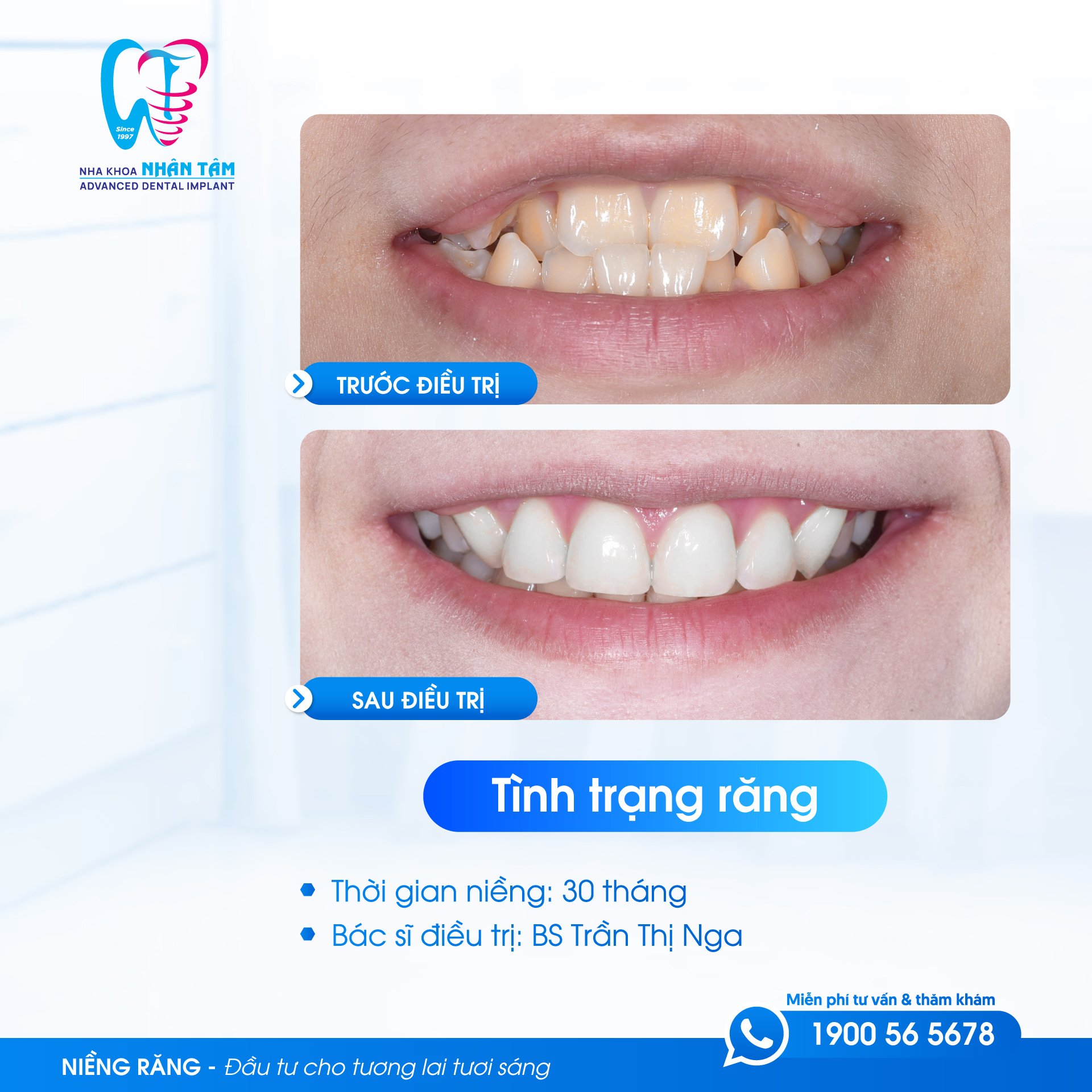 Niềng răng mắc cài kim loại và niềng răng mắc cài sứ ở trẻ Niềng răng mắc cài kim loại và niềng răng mắc cài sứ ở trẻ