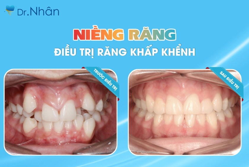 Niềng răng mang lại nhiều lợi ích tuyệt vời Niềng răng mang lại nhiều lợi ích tuyệt vời