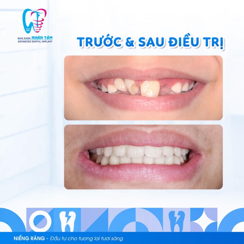 Kết quả niềng răng tại Nha khoa Nhân Tâm Kết quả niềng răng tại Nha khoa Nhân Tâm