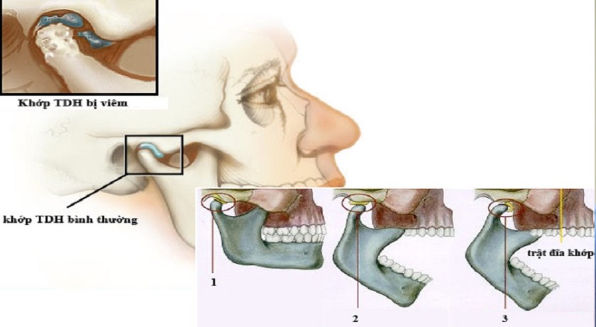 Rối loạn khớp thái dương hàm