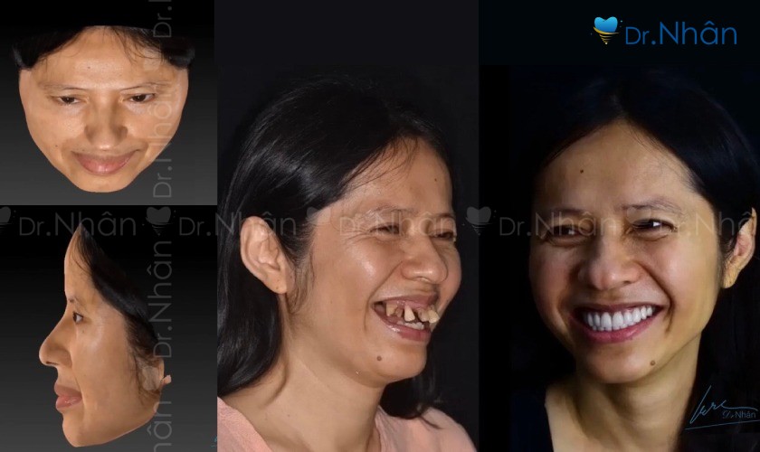 Công nghệ Facial Scan 3D do Nha khoa Nhân Tâm nghiên cứu và cải tiến dựa trên công nghệ thiết kế nụ cười 2D Công nghệ Facial Scan 3D do Nha khoa Nhân Tâm nghiên cứu và cải tiến dựa trên công nghệ thiết kế nụ cười 2D