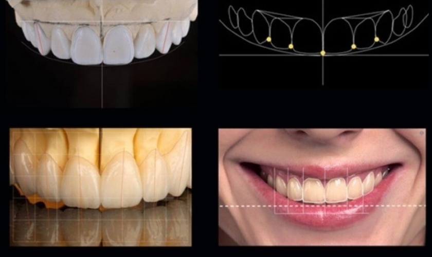 Thiết kế nụ cười giúp nâng cao hiệu quả thẩm mỹ khi bọc sứ