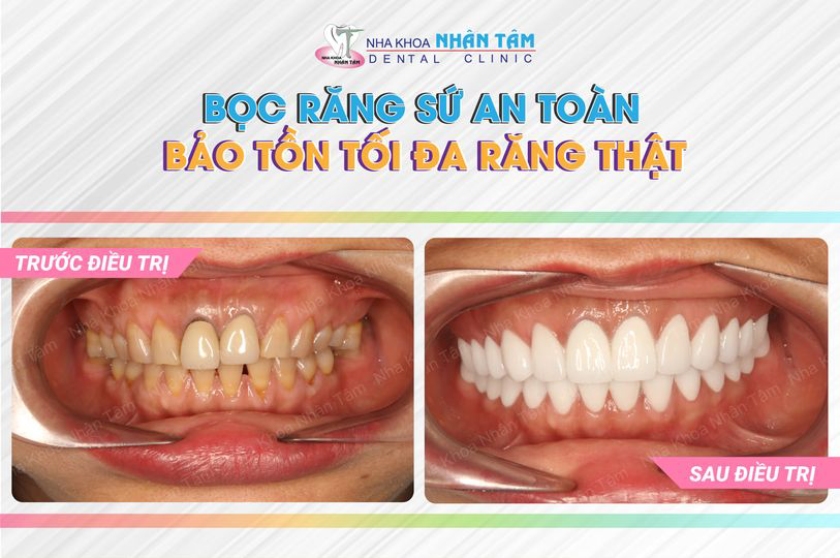 Khách hàng làm răng sứ thẩm mỹ tại Nha khoa Nhân Tâm