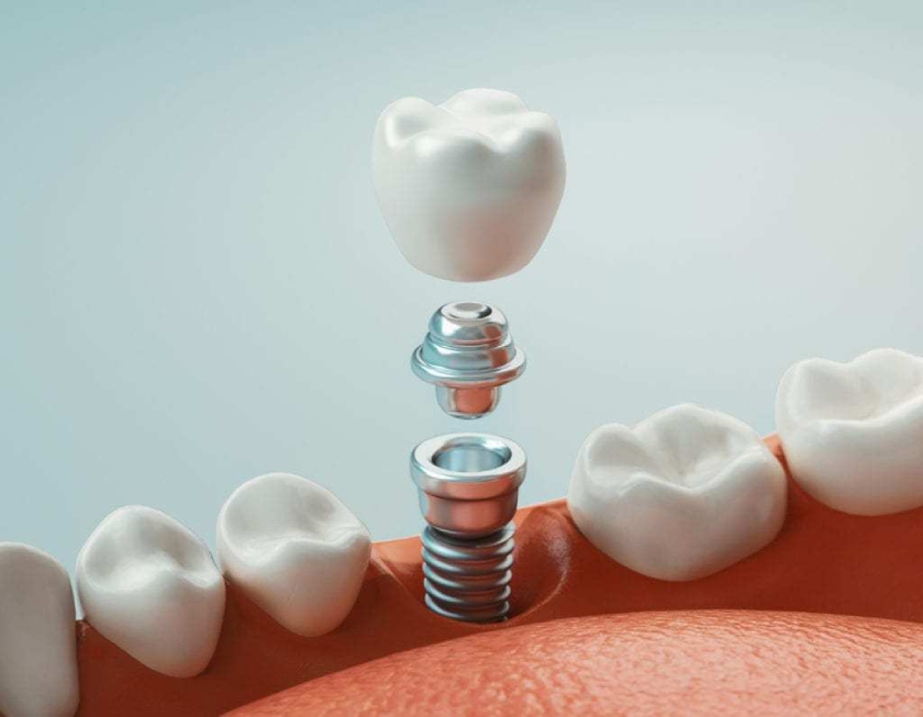 Mão sứ được gắn lên bên trên trụ Implant để tạo thành một chiếc răng giả có đầy đủ chân răng và thân răng