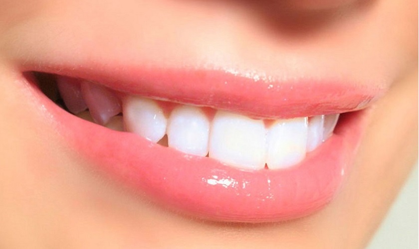 Răng sứ thẩm mỹ - Giải pháp tối ưu khắc phục khuyết điểm của răng