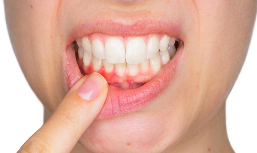 Viêm lợi sau khi bọc răng sứ là gì ?