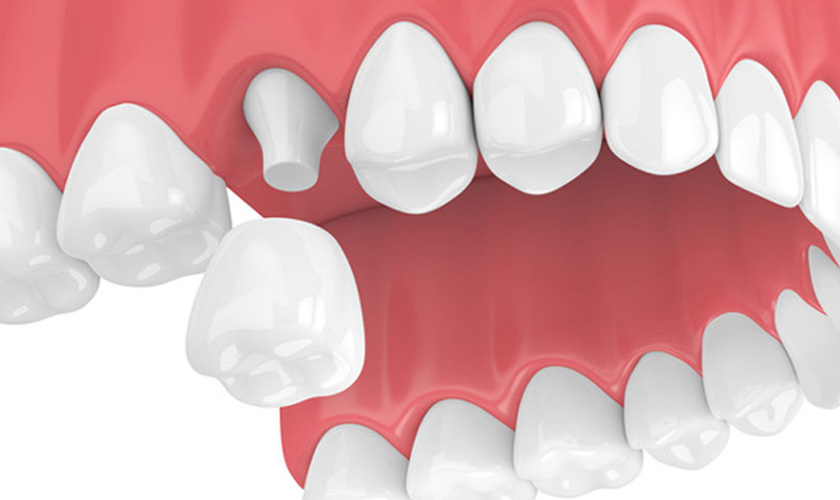 Có bọc răng sứ để điều trị sâu răng cho trẻ được không?