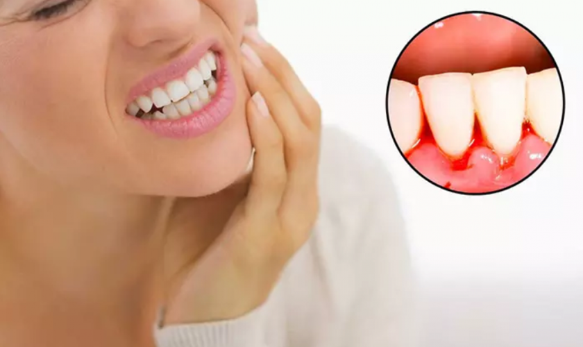 Nguyên nhân nào gây viêm lợi sau khi bọc răng sứ?