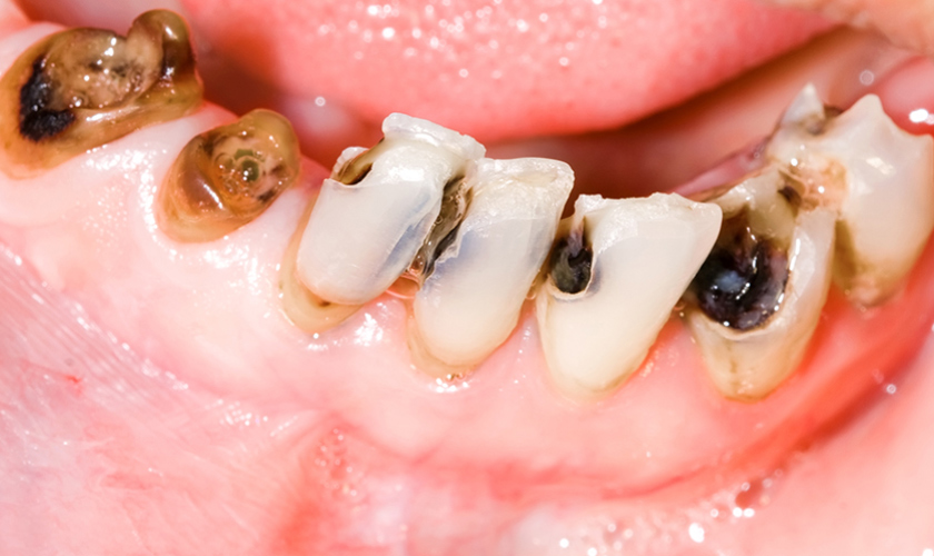 Tại sao nên bọc răng sứ cho răng sâu?