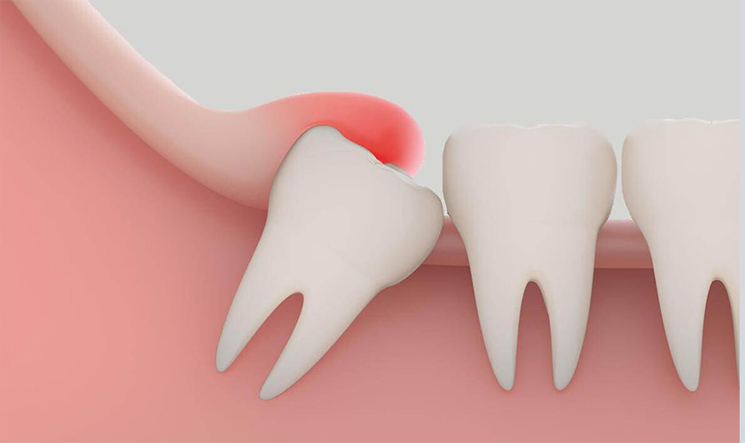 Biến chứng nhổ răng khôn là gì? Có nguy hiểm không?