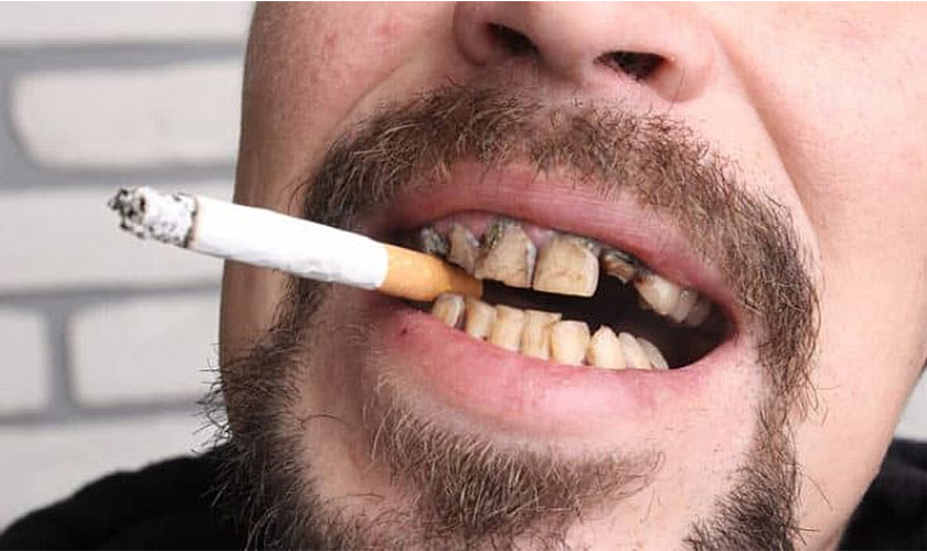 Cách làm trắng răng cho người hút thuốc lá