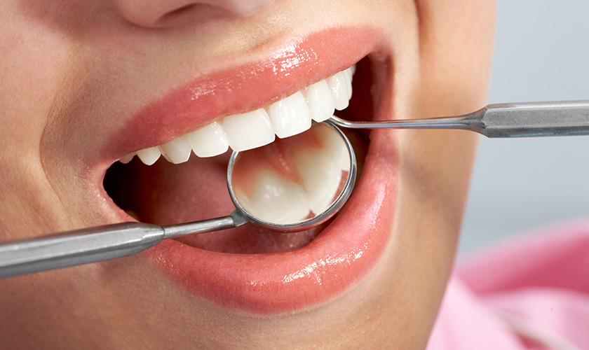 Trám răng thẩm mỹ phục hồi răng hư tổn