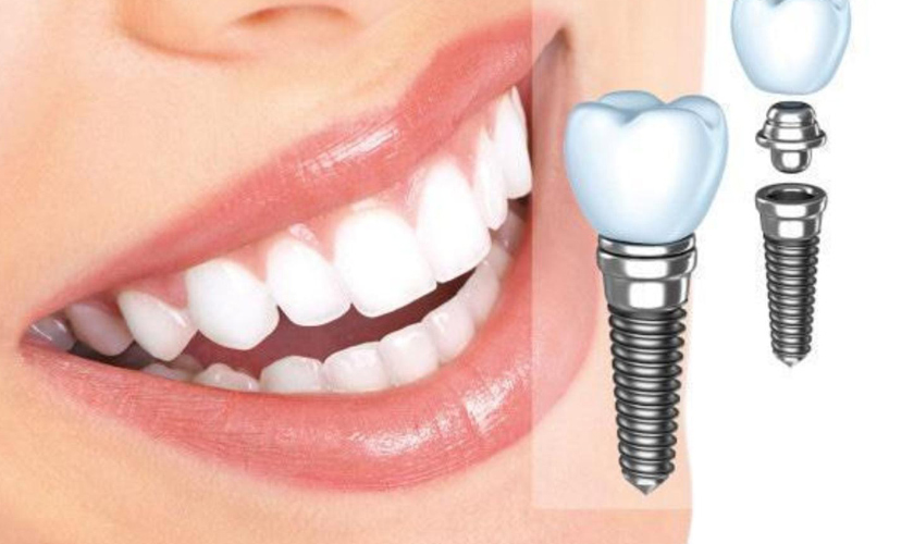 Vì sao cấy ghép răng implant là giải pháp phục hình răng tối ưu?