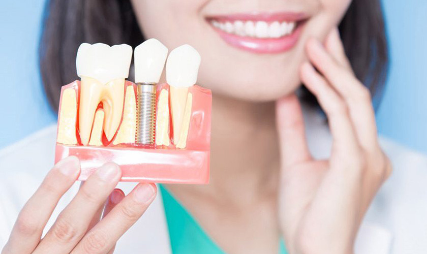 Hướng dẫn chăm sóc răng miệng và ngừa viêm chân răng sau cấy ghép implant