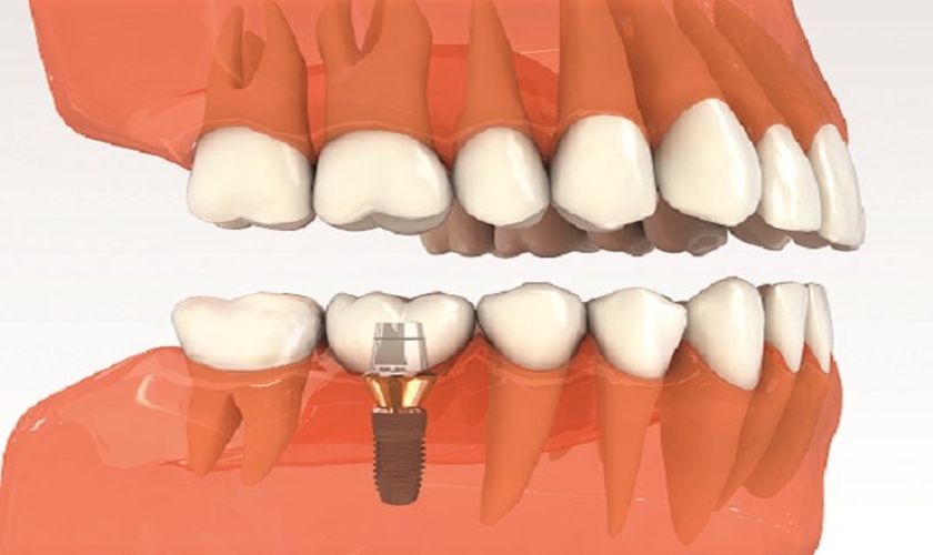 Làm thế nào để kéo dài tuổi thọ răng implant?