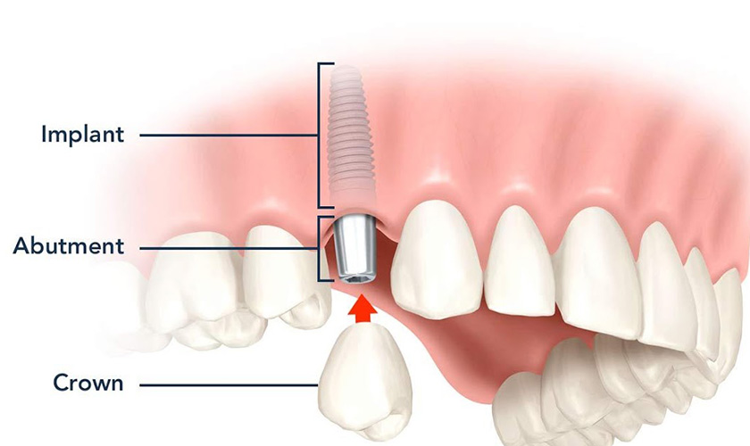 Trồng răng implant có bị hôi miệng không?
