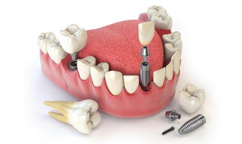 Trồng răng implant có đau không? Ở đâu cấy ghép implant không đau?