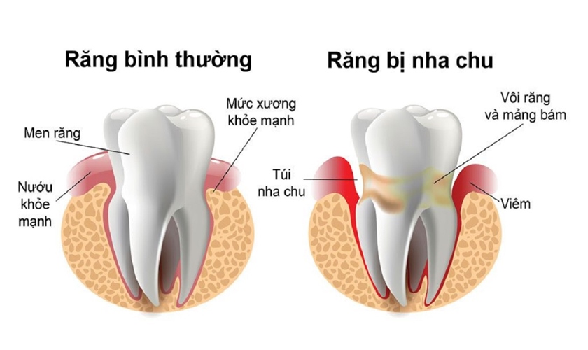 Viêm nha chu có ảnh hưởng đến trồng răng implant không?