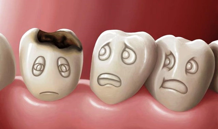 Cách chữa răng sâu khi niềng răng và phương pháp phòng ngừa