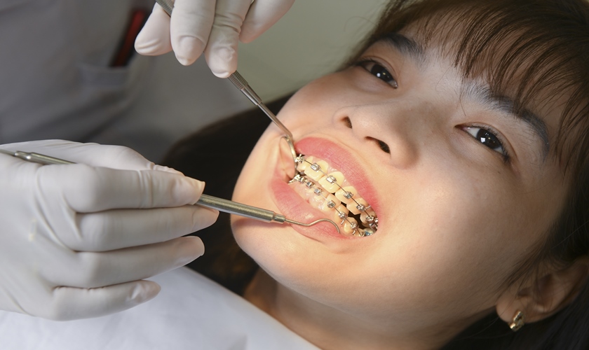 Nguyên nhân nào gây tái phát sau khi niềng răng?