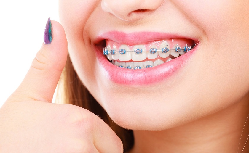 Niềng răng có phải nhổ răng không? Niềng răng có phải nhổ răng không?