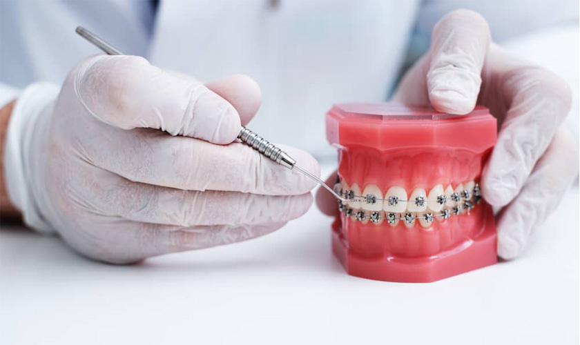 Niềng răng một hàm và hai hàm có gì khác nhau?