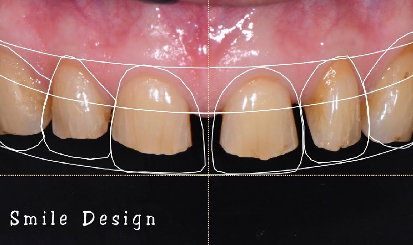 Công nghệ thiết kế nụ cười giúp khách hàng thấy trước nụ cười trong tương lai