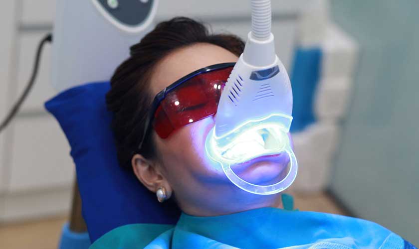 Công nghệ tẩy trắng răng bằng Laser