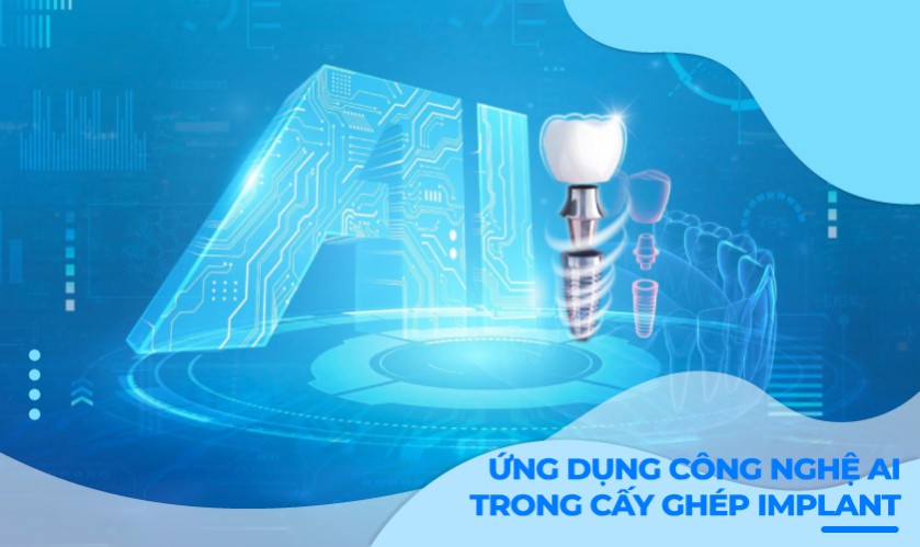 Quy trình cấy ghép implant với công nghệ AI: An toàn, nhanh chóng, ít đau