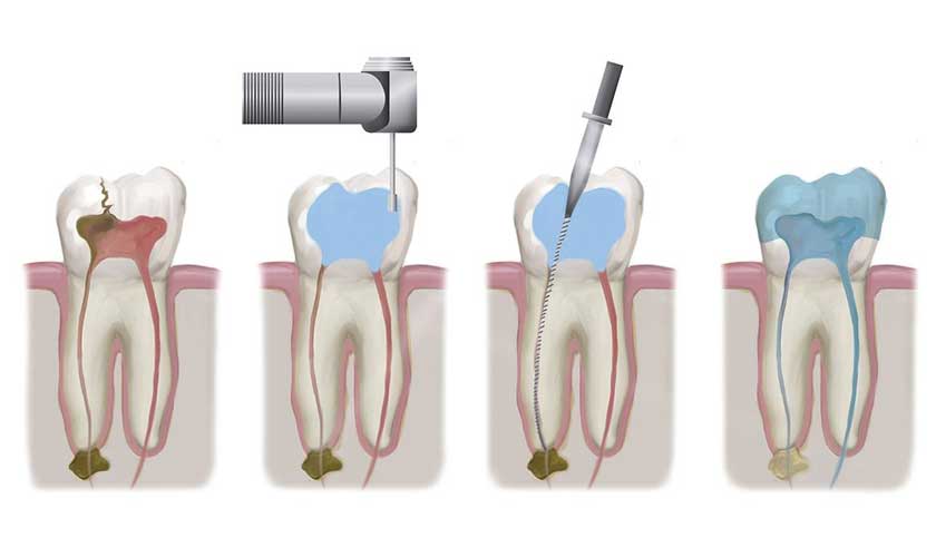 Kỹ thuật chữa tủy cần thực hiện chính xác, an toàn, đảm bảo đầy đủ các nguyên tắc điều trị tủy