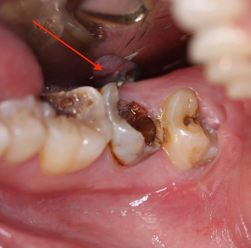 Răng bị viêm tủy, nhiễm trùng tủy do sâu răng nghiêm trọng