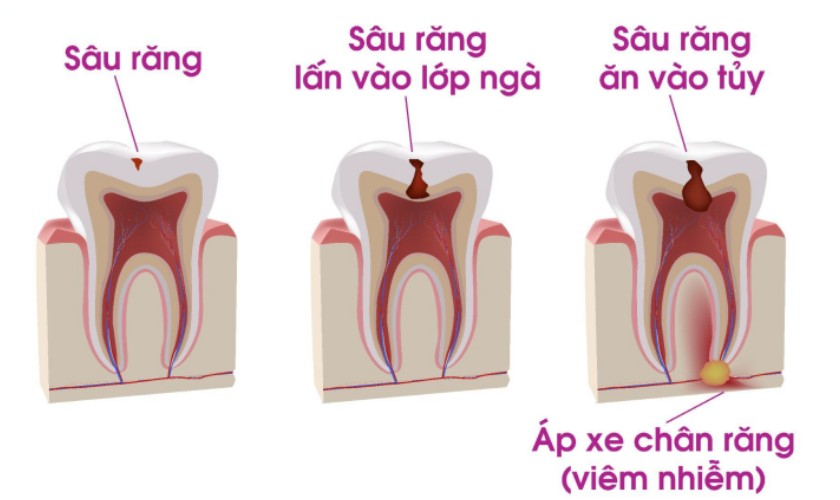 Viêm tủy răng nếu không điều trị kịp thời sẽ dẫn đến áp-xe chân răng vô cùng nguy hiểm