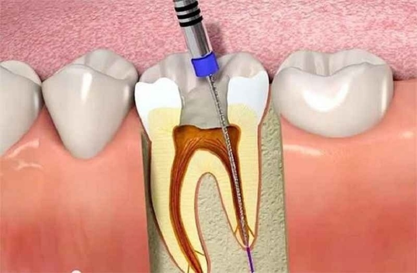 Điều trị tủy răng giúp loại bỏ mô tủy răng bị viêm, ngăn ngừa những biến chứng khôn lường