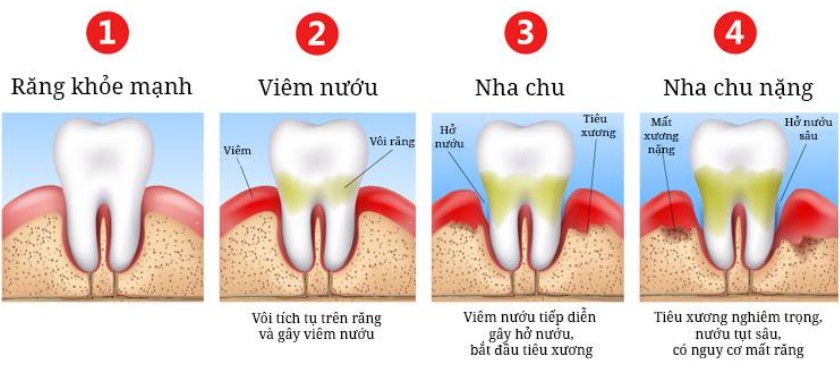 Viêm nướu răng nếu không điều trị kịp thời sẽ dẫn đến viêm nha chu